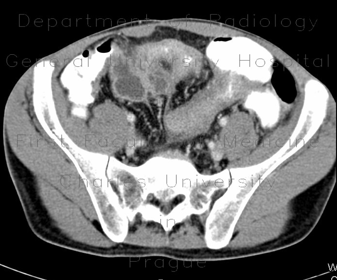 Radiology image - Mesenteric abscess, Crohn