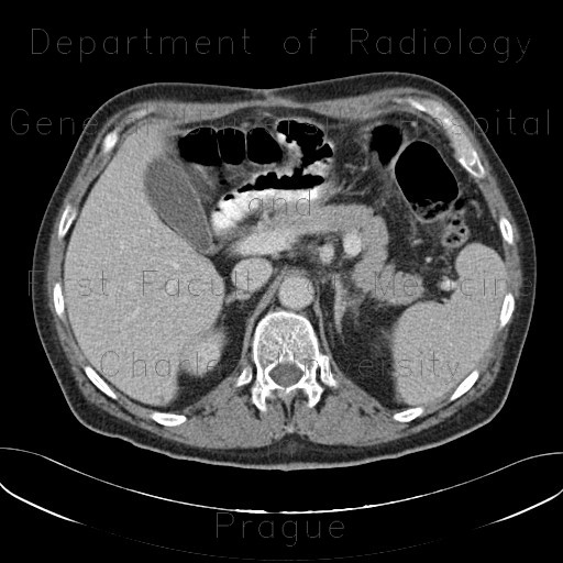 Mesenteric abscess, gastroenteroanastomosis, end-to-side, small-bowel stenosis