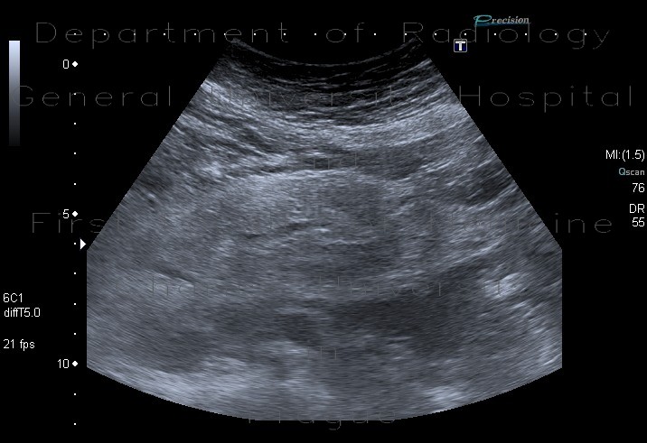 Mesenteric lipodystrophy, paniculitis