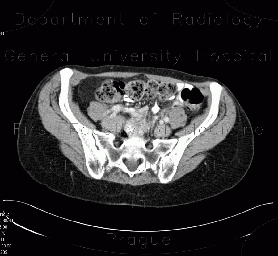 Radiology image - Mesenteric lipomatosis in steroid treatment: Abdomen, Peritoneal cavity: CT - Computed tomography