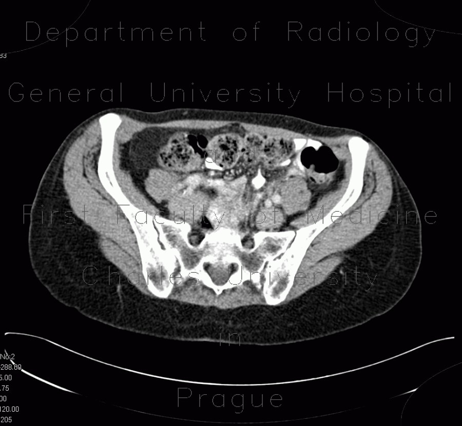 Mesenteric lipomatosis in steroid treatment