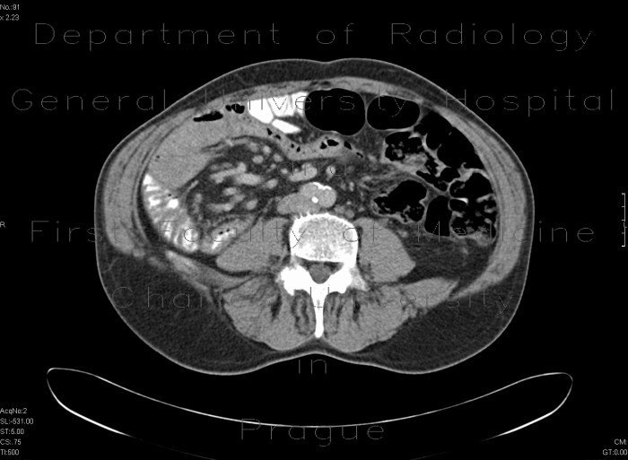 Radiology image - Mesenterium commune, gut malrotation: Abdomen, Large bowel, Peritoneal cavity: CT - Computed tomography