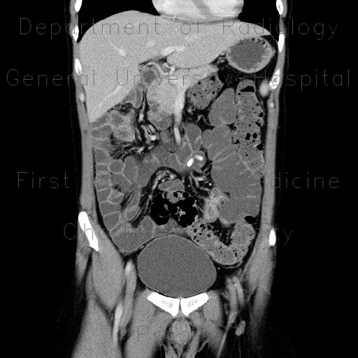 Mesenterium commune, gut malrotation, Crohn's disease of terminal ileum