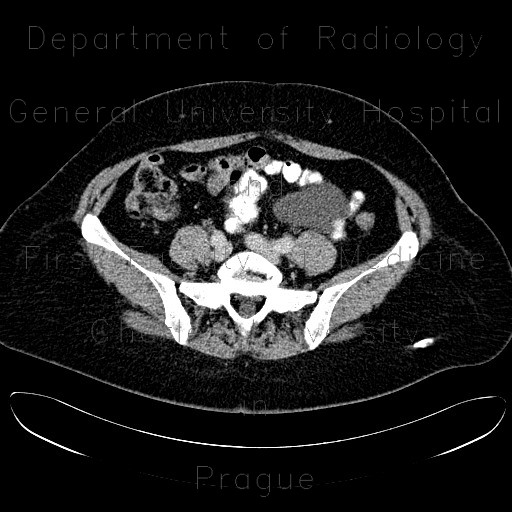 Radiology image - Mesentric cyst, mesothelial cyst: Abdomen, Peritoneal cavity: CT - Computed tomography