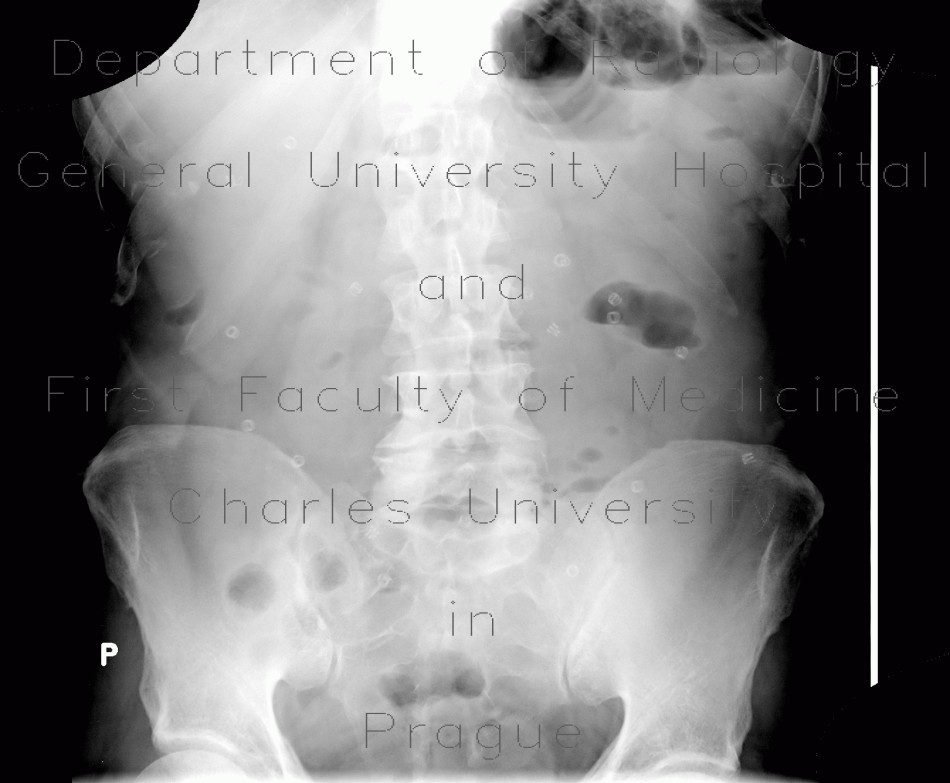 Radiology image - Metallic coils in abdomen: Abdomen, Peritoneal cavity: X-ray - Plain radiograph
