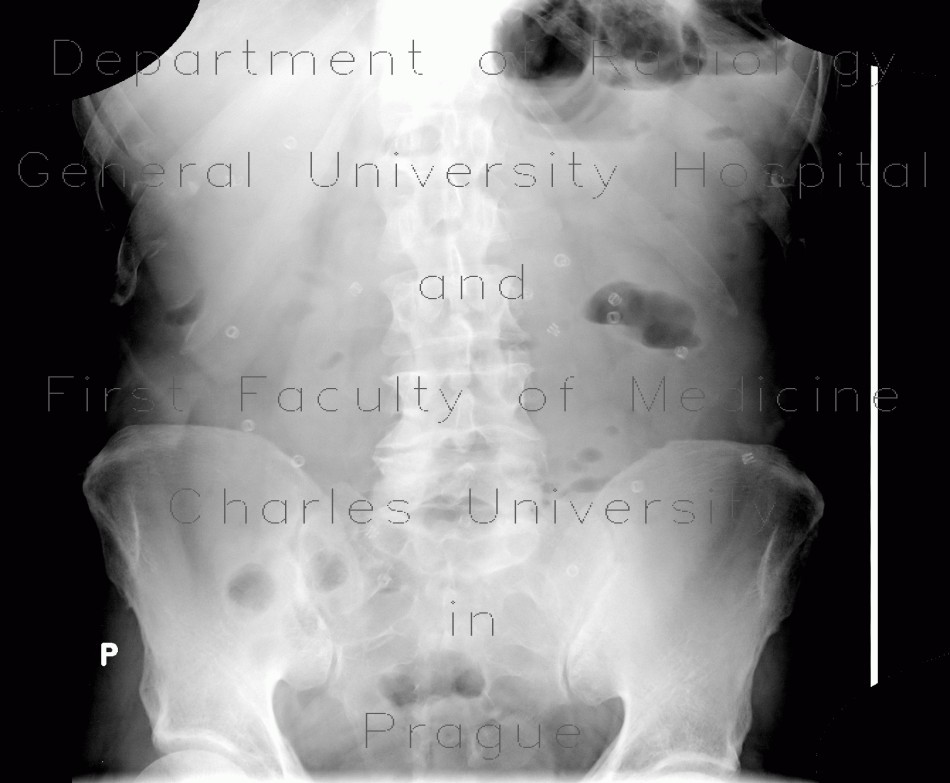 Metallic coils in abdomen