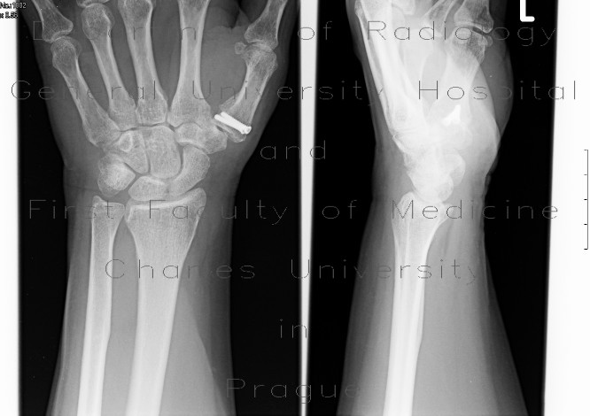 Radiology image - Metalosis, Bennet