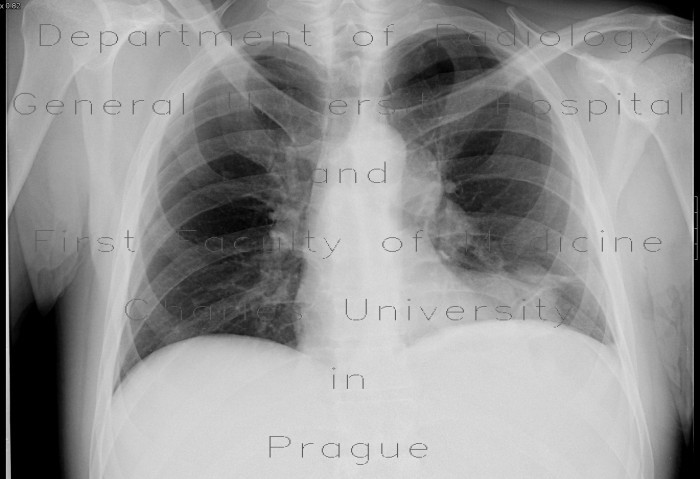 Metastases of lung and mediastinum