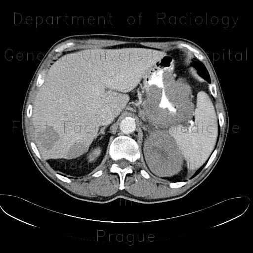 Radiology image - Metastases of malignant melanoma, liver, stomach, adrenal gland, retroperitoneal lymph nodes: Abdomen, Kidney and adrenals, Liver, Lymphatic, Stomach: CT - Computed tomography
