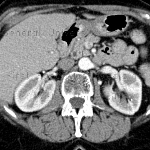 Metastasis in duodenal wall