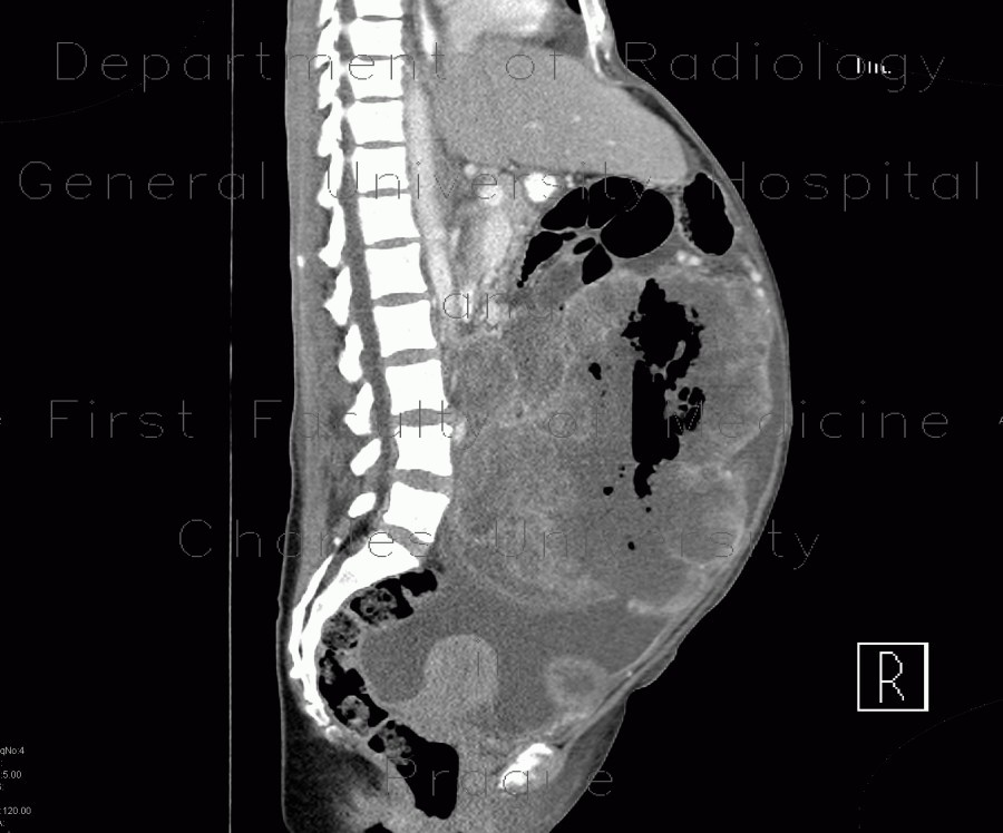 Radiology image - Metastasis of malignant melanoma in peritoneal cavity: Abdomen, Peritoneal cavity, Soft tissue: CT - Computed tomography