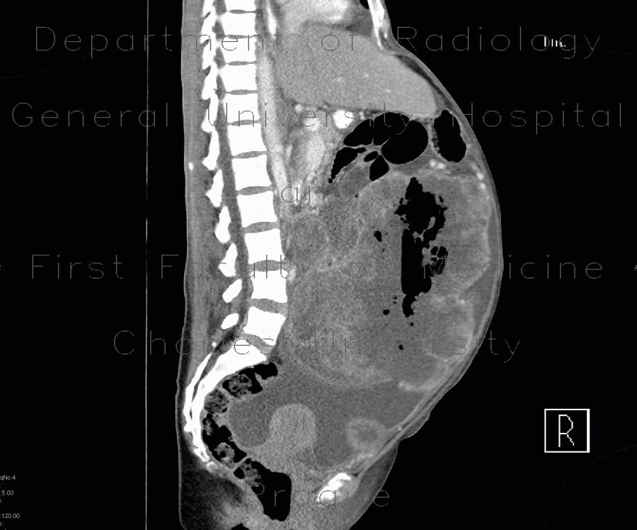 Metastasis of malignant melanoma in peritoneal cavity