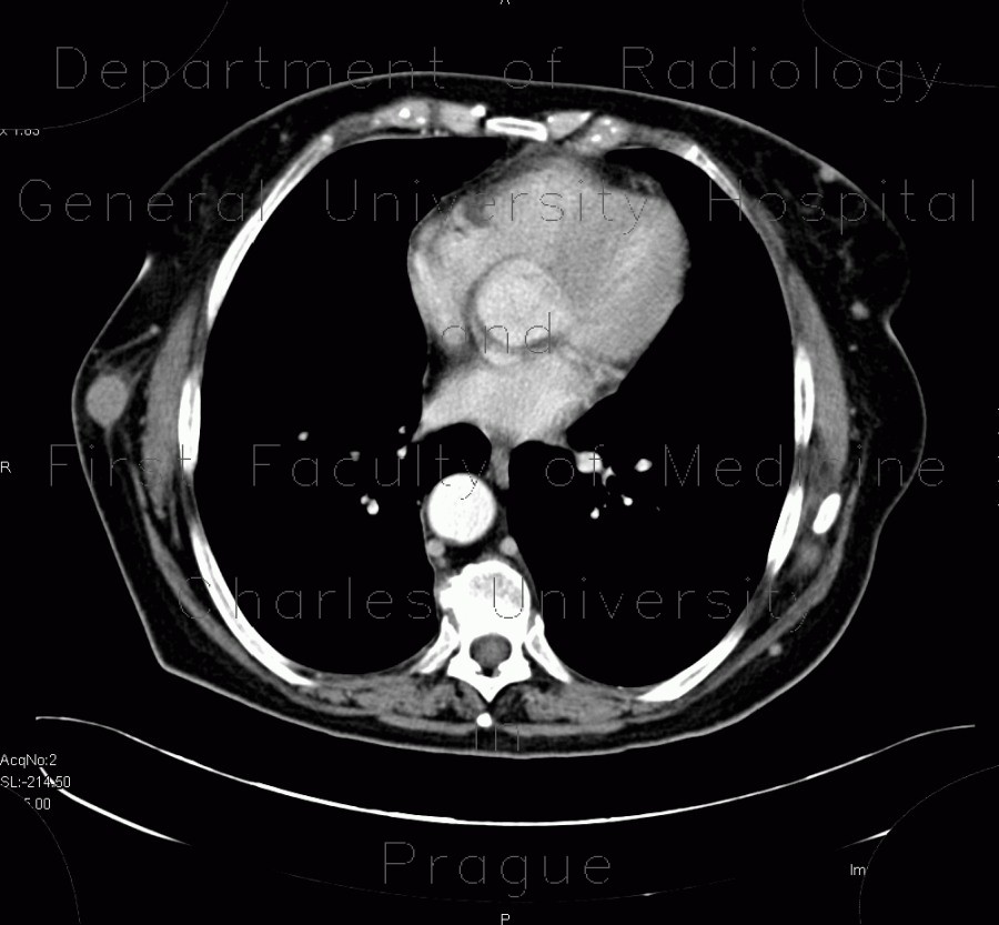 Radiology image - Metastasis of malignant melanoma into skin: Abdomen, Thorax, Soft tissue: CT - Computed tomography