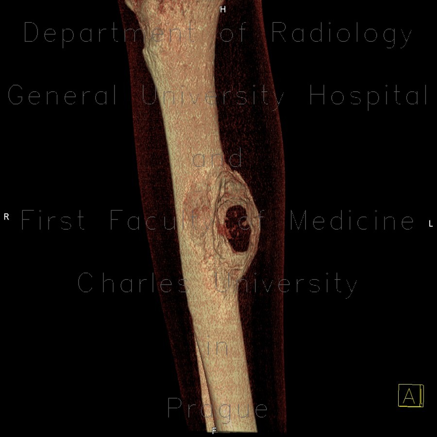 Metastasis of melanoma in the tibia