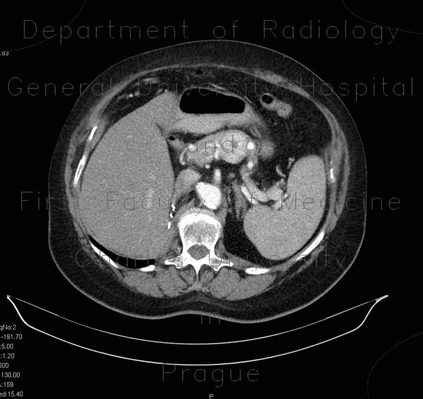 Radiology image - Metastasis of renal cell carcinoma in pancreas and adrenal gland, nephrectomy: Abdomen, Kidney and adrenals, Pancreas: CT - Computed tomography