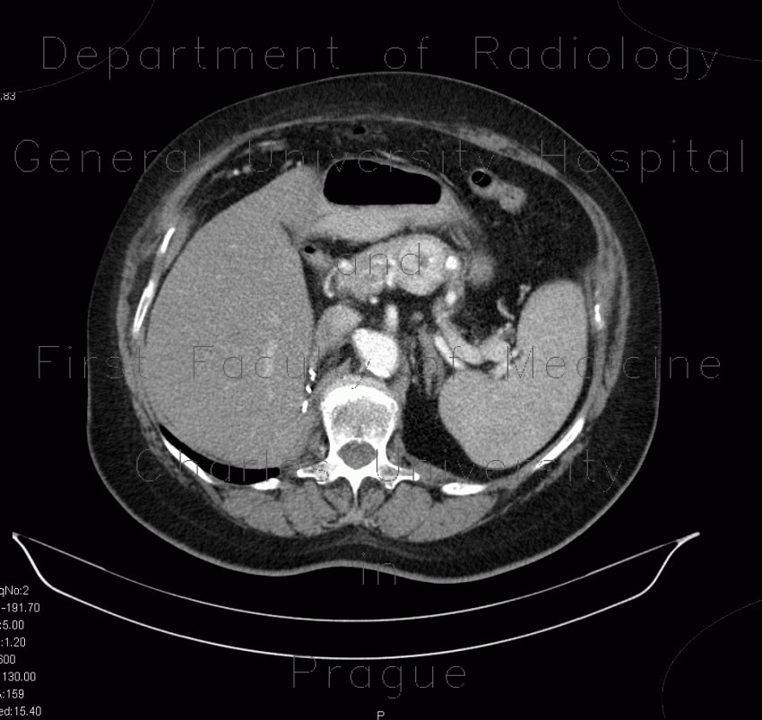 Metastasis of renal cell carcinoma in pancreas and adrenal gland, nephrectomy
