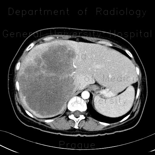 Radiology image - Metastasis of tubular carcinoma of large bowel, colorectal carcinoma, hemihepatectomy: Abdomen, Liver: CT - Computed tomography