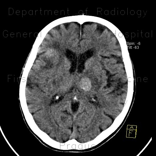 Metastatic disease of the brain