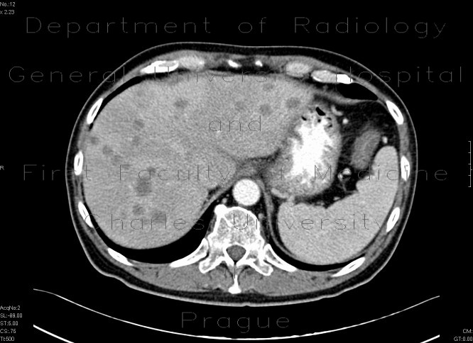 Metastatic disease of the liver, stomach carcinoma