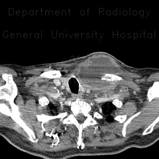 Metastatic infiltration of lymph node, osteolysis of clavicle