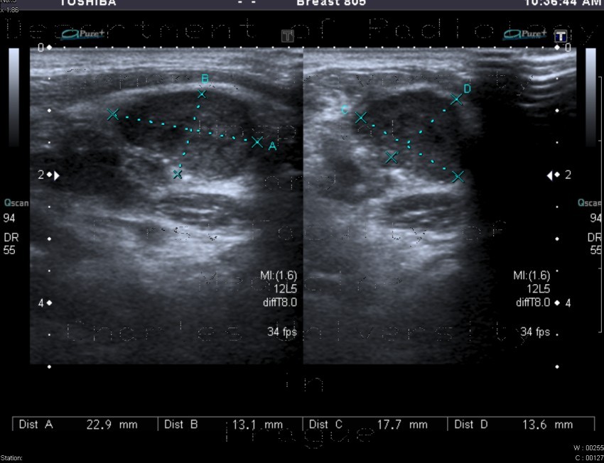 Radiology image - Metastatic infiltration of lymph nodes: Head and Neck, Lymphatic: US - Ultrasound