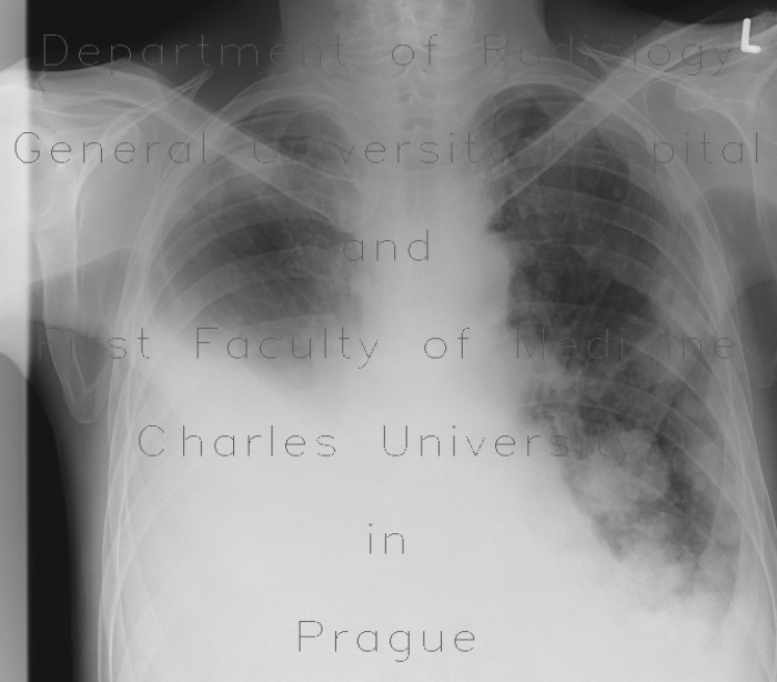 Metastatic lung disease, pleural effusion