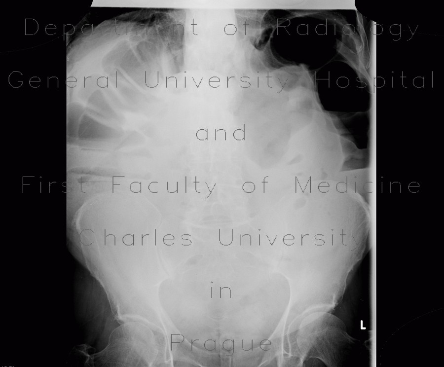 Meteorism, distention of colon, reflex distention, vertebrogenic pain syndrome, compression fracture of vertebra