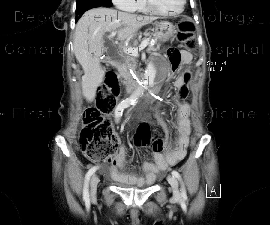 Migration of biliary drain, perforation of duodenum