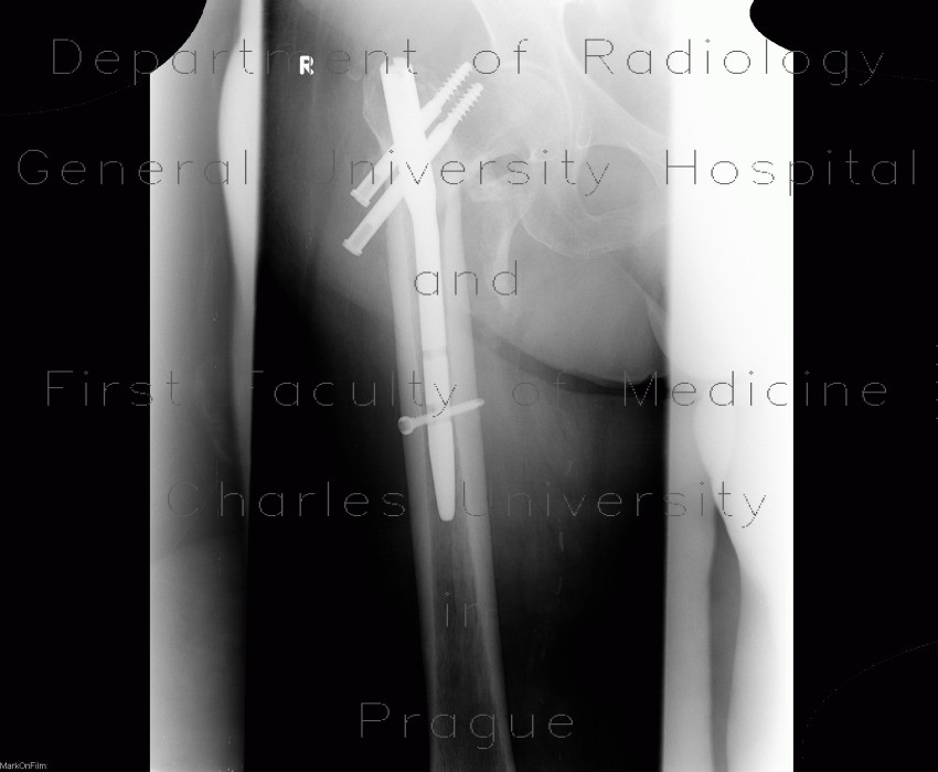 Radiology image - Migration of hardware, second radiograph, intramedullary hip screw: Extremity, Bone: X-ray - Plain radiograph