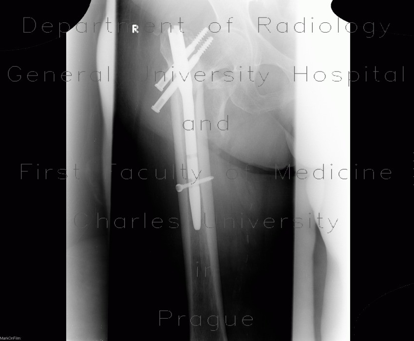 Migration of hardware, second radiograph, intramedullary hip screw