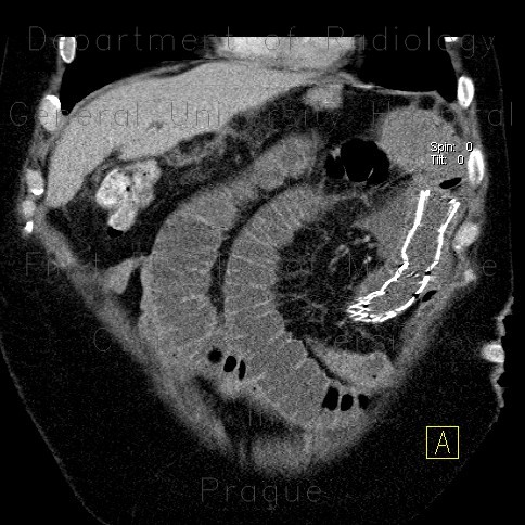 Radiology image - Migration of stent, ileus: Abdomen, Other, Small bowel: CT - Computed tomography
