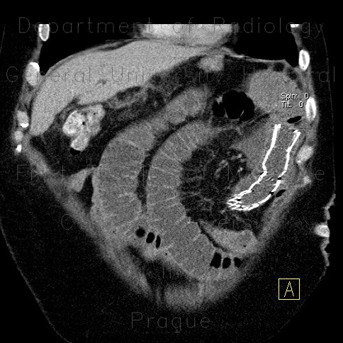 Migration of stent, ileus