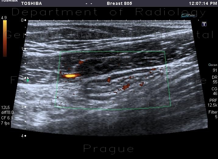 Radiology image - Mild colitis: Abdomen, Large bowel: US - Ultrasound