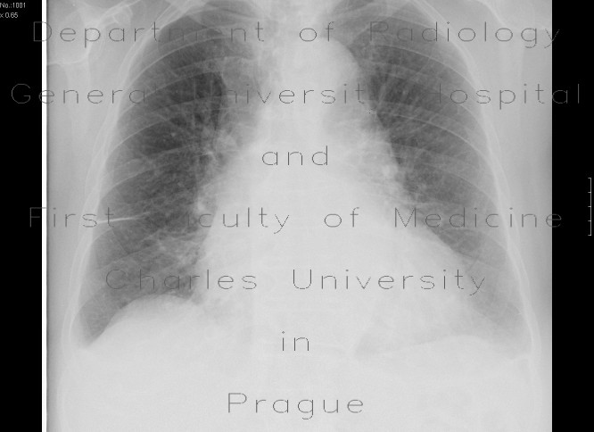 Radiology image - Mild lung congestion: Thorax, Lung: X-ray - Plain radiograph