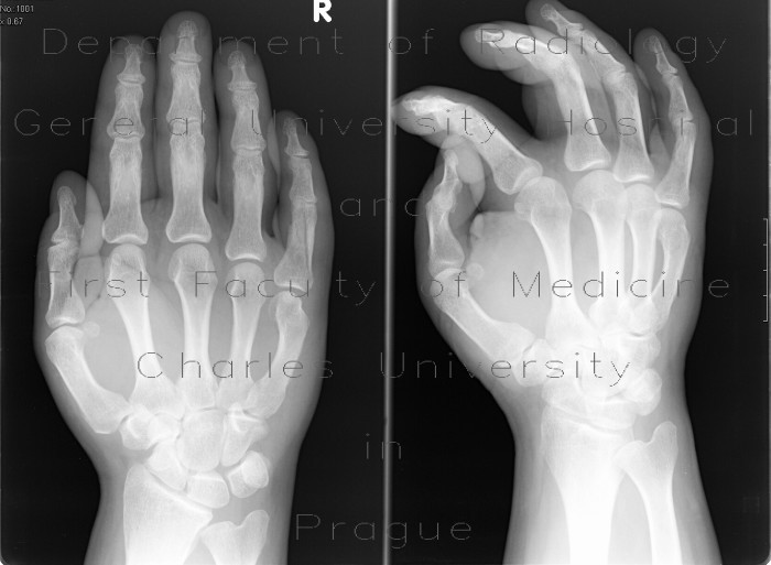 Radiology image - Minus variant of ulna, intraarticular fracture of proximal phalanx of fifth finger: Extremity, Bone: X-ray - Plain radiograph