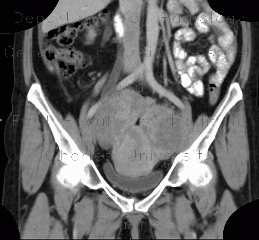 Mixed adenoneuroendocrine tumour of appendix, mixed tumour, hydronephrosis, ascites