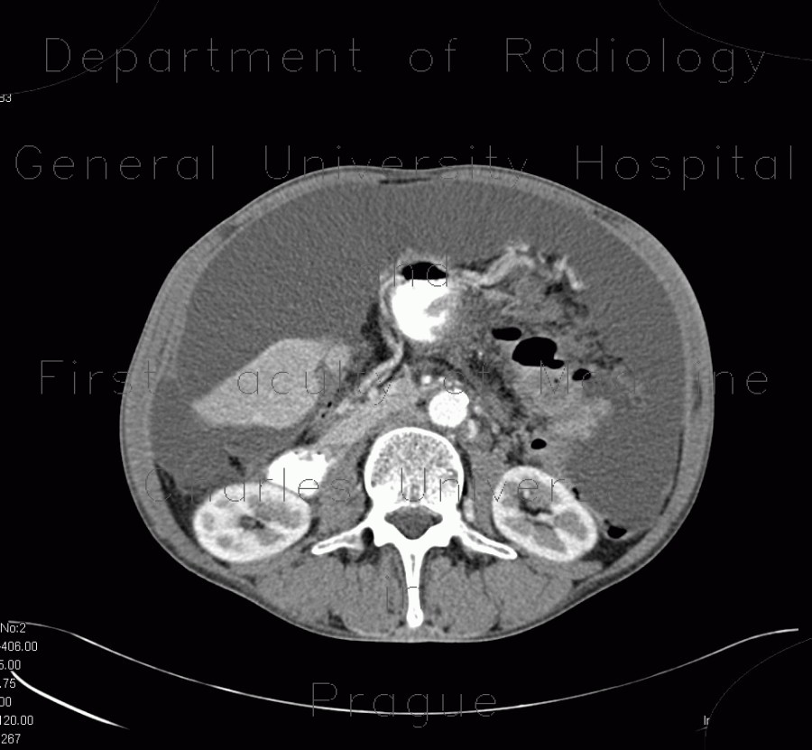 Mixed tumour of appendix, carcinoid and adenocarcinoma, carcinomatous peritonitis