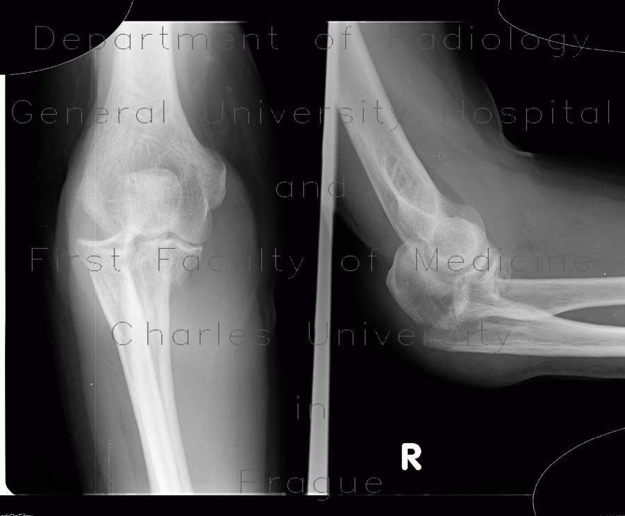 Monteggia fracture of proximal ulna and head of radius, type II