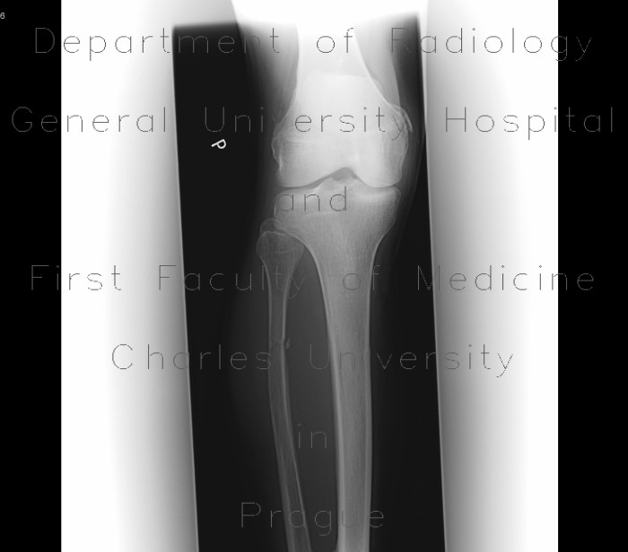 Morbus Stieda-Pellegrini, fracture of proximal fibula