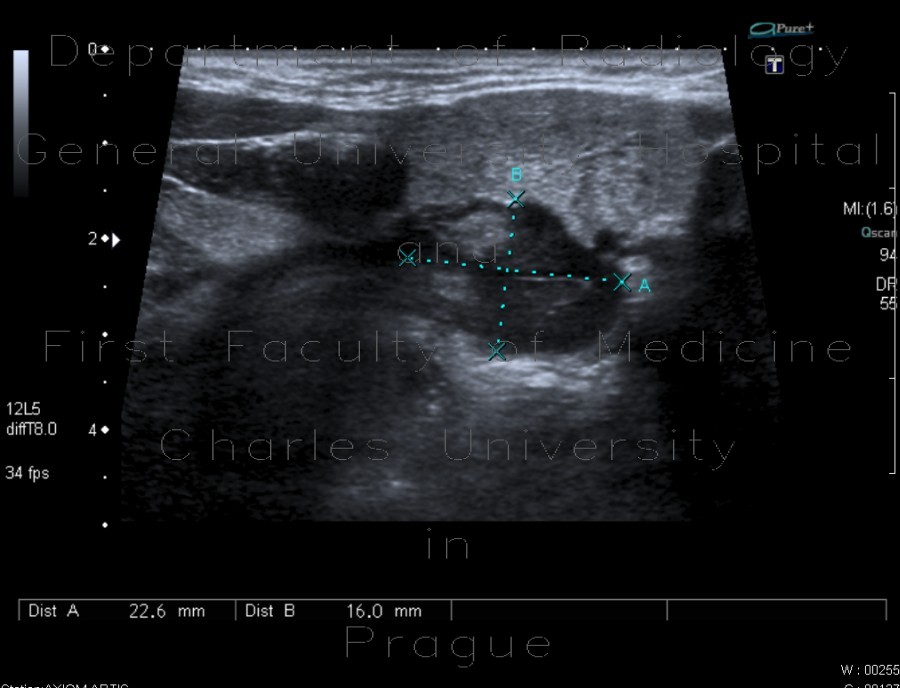 Mucocoele of submandibular gland