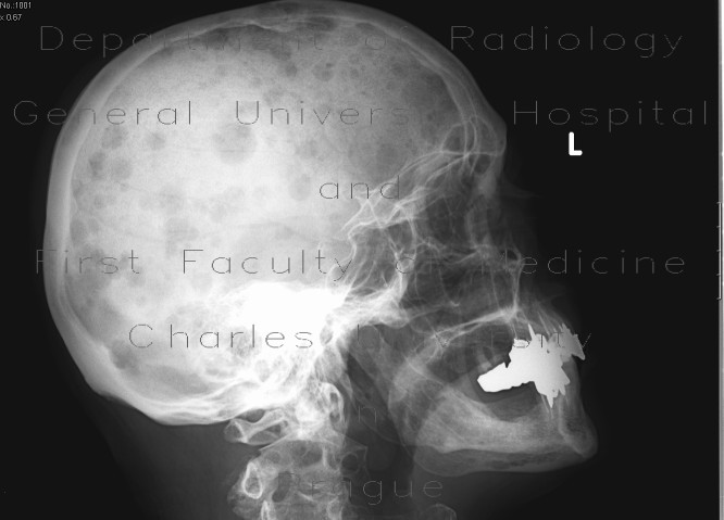 Radiology image - Multiple myeloma, lytic lesions: Spine and Axial, Bone: X-ray - Plain radiograph