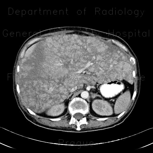 Multiple myeloma, venooclusive disease of liver, hypervascular nodules