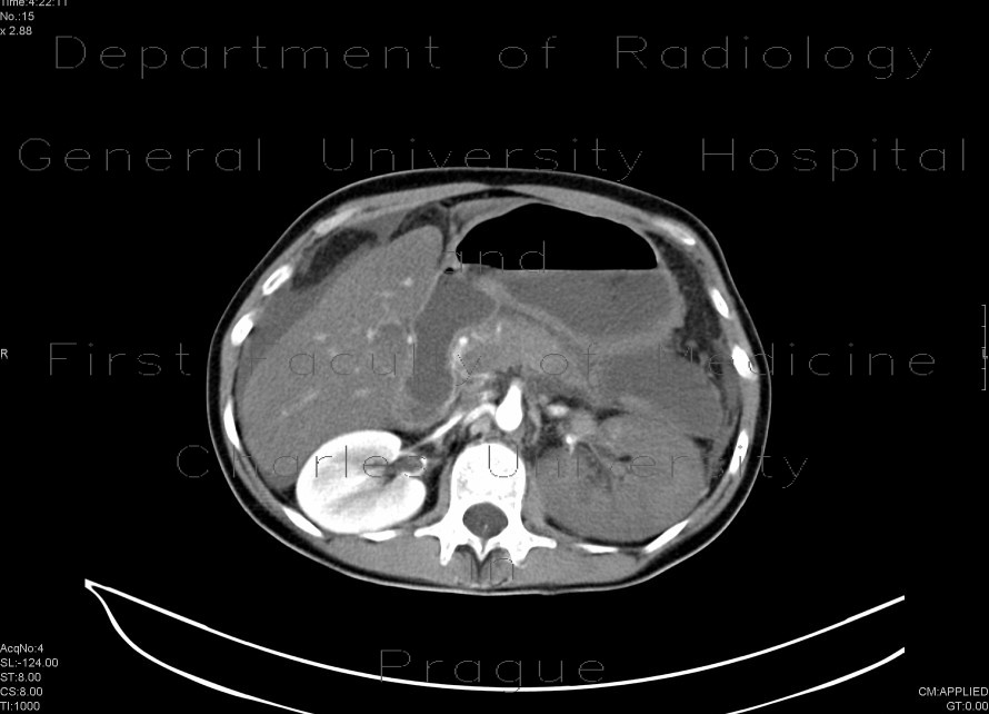 Radiology image - Multiple visceral thromboses of unknown etiology: Abdomen, Kidney and adrenals, Large bowel, Liver, Peritoneal cavity, Small bowel: CT - Computed tomography