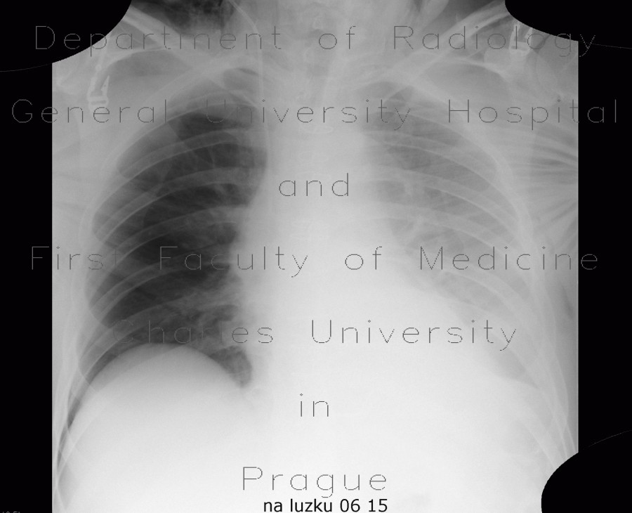 Muscular emphysema, pleural effusion, deep sulcus sign, pneumothorax, PNO