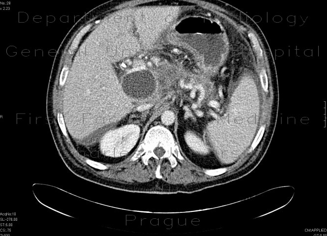 Radiology image - Mutliple pseudocysts of the pancreas following acute pancreatitis: Abdomen, Pancreas, Peritoneal cavity: CT - Computed tomography