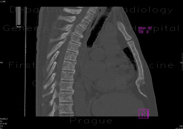 Radiology image - Myelofibrosis: Spine and Axial, Thorax, Bone, Lung: CT - Computed tomography