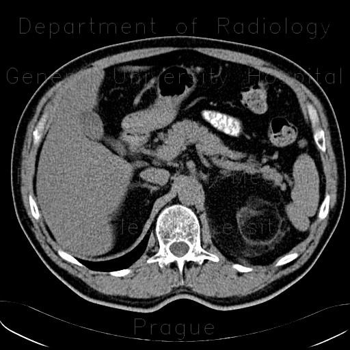Radiology image - Myelolipoma, adrenal: Abdomen, Kidney and adrenals: CT - Computed tomography