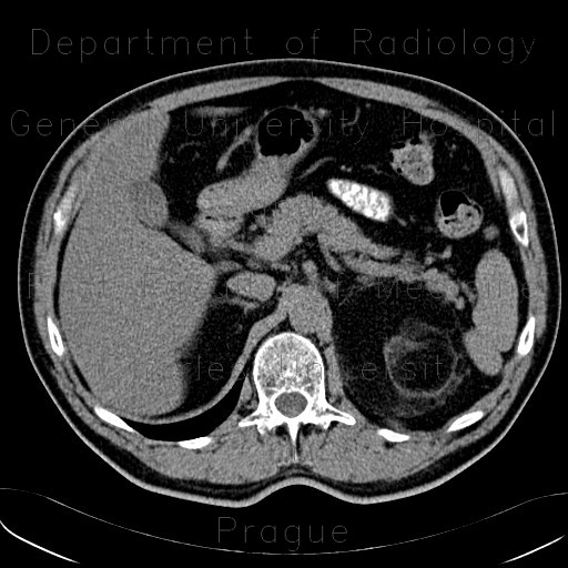 Myelolipoma, adrenal