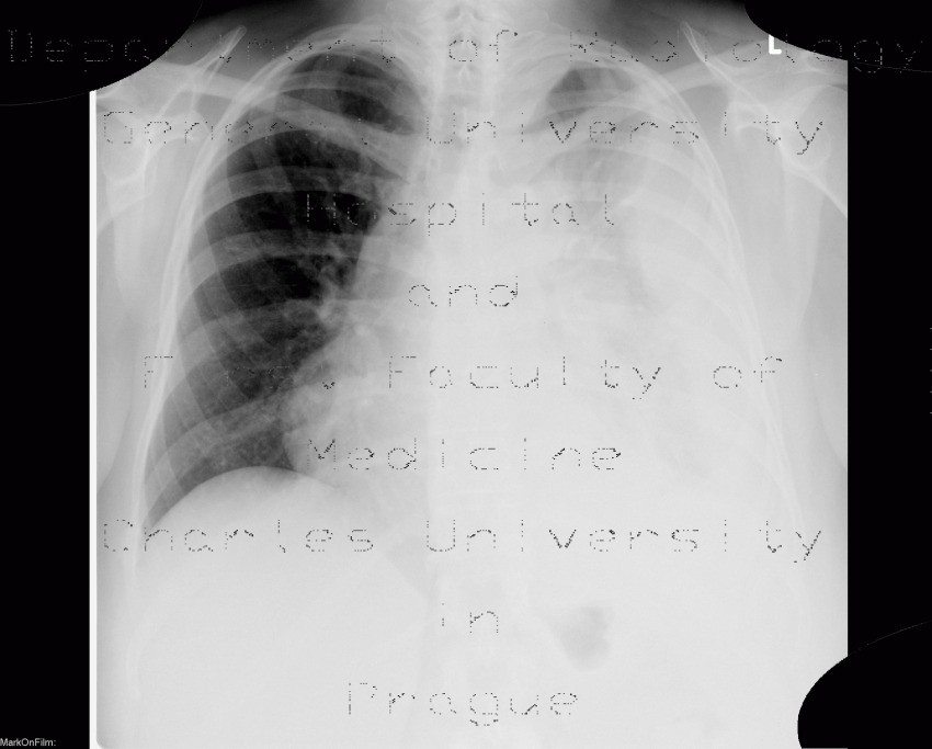 Myeloma of thorax wall
