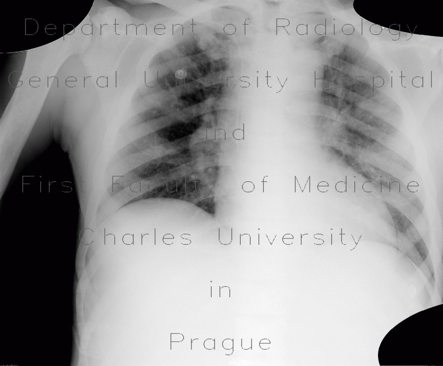 Myeloproliferative disorder, skeletal changes